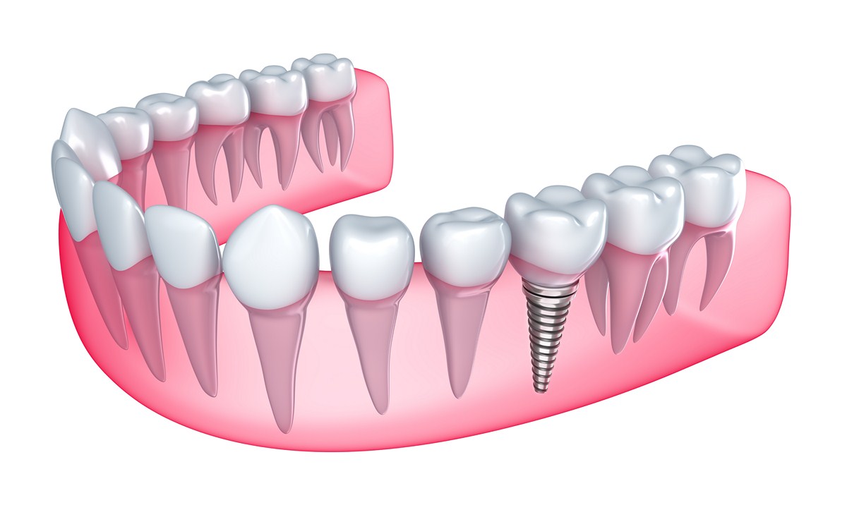 Implantology01